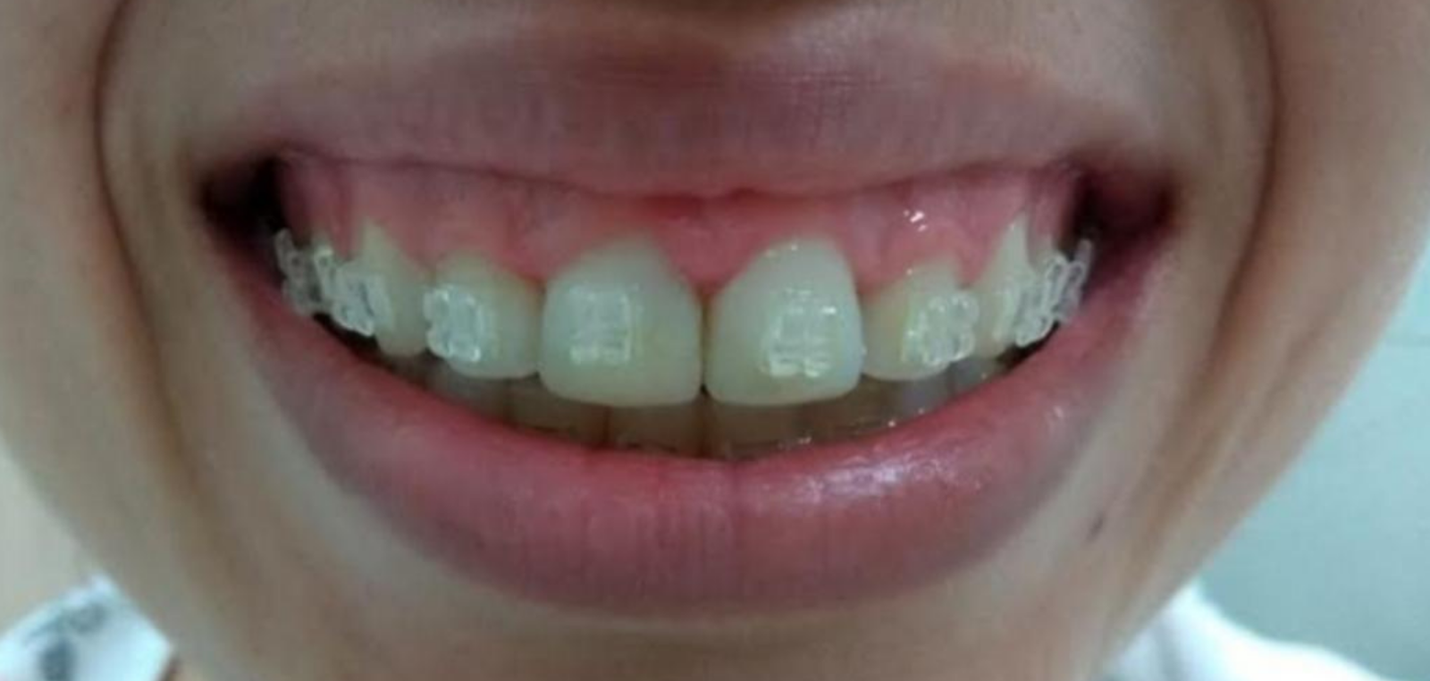 Antes