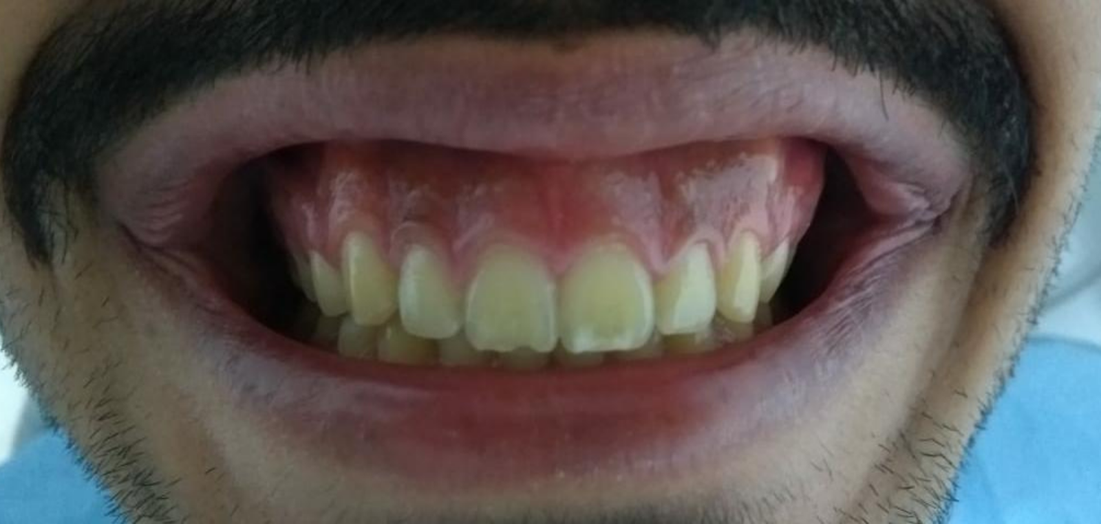 Antes