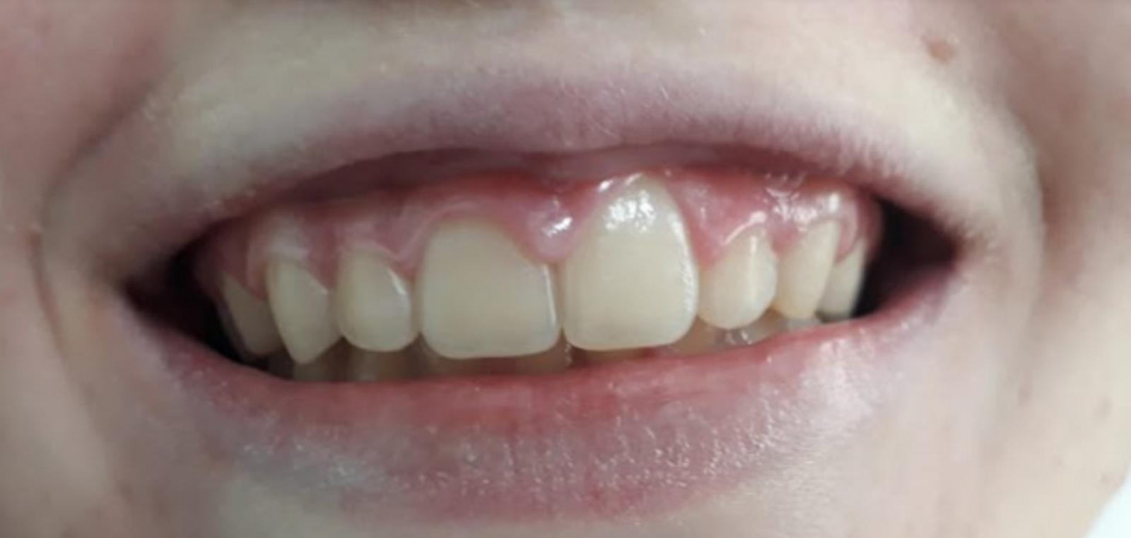 Antes